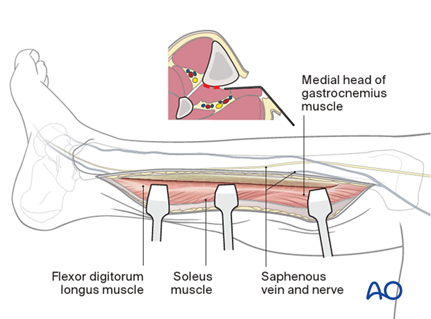 42_A060_i100 Approach to the posteromedial surface of the tibial shaft - the dissection should be done in an extra-periosteal plane.