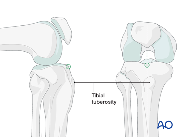 Infrapatellar approach for intramedullary nailing of the tibial shaft - determination of the entry point