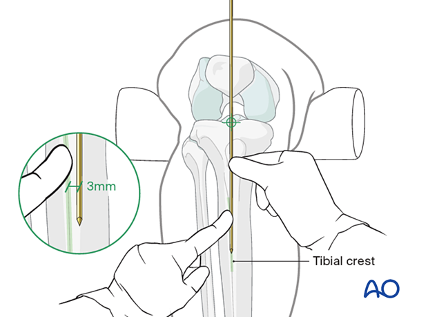  Infrapatellar approach for intramedullary nailing of the tibial shaft - to find the correct entry point, identify the tibial crest and place a guide wire along it, extending proximally over the knee.