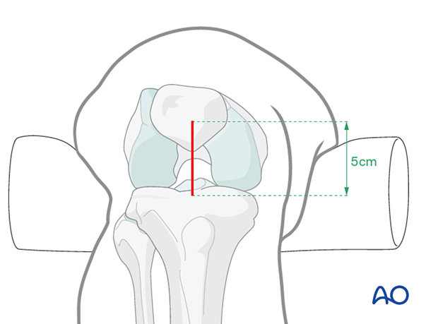 Infrapatellar approach for intramedullary nailing of the tibial shaft - skin incision