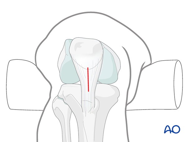 Infrapatellar approach for intramedullary nailing, Tendon incision