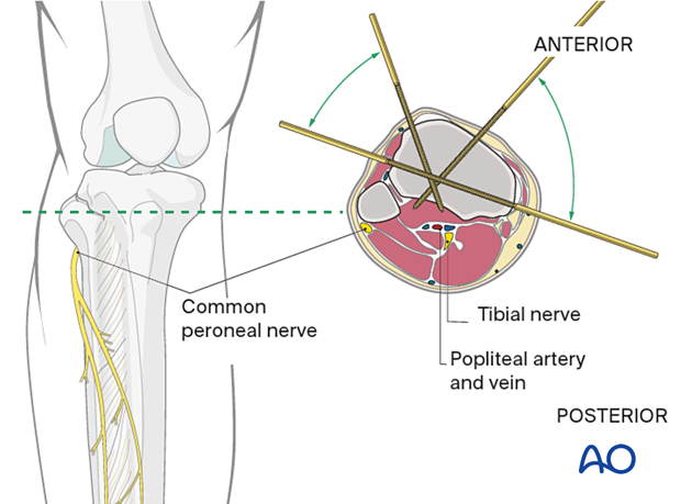 42_A080_i020 Safe zones of the tibia for pin insertion