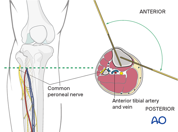 42_A080_i040 Safe zones of the tibia for pin insertion