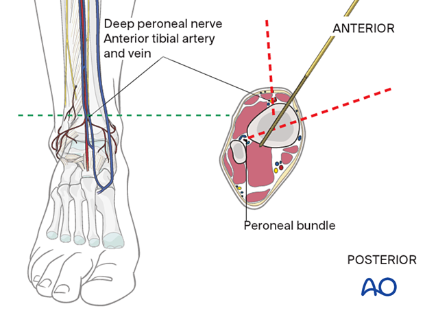 42_A080_i080 safe zones of the tibia for pin insertion