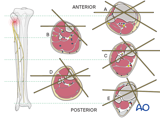 Safe zones in the tibia for wire insertion