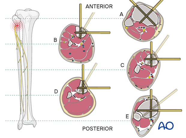 42_A080_i120 Safe zones in the tibia for wire and Schanz screw insertion