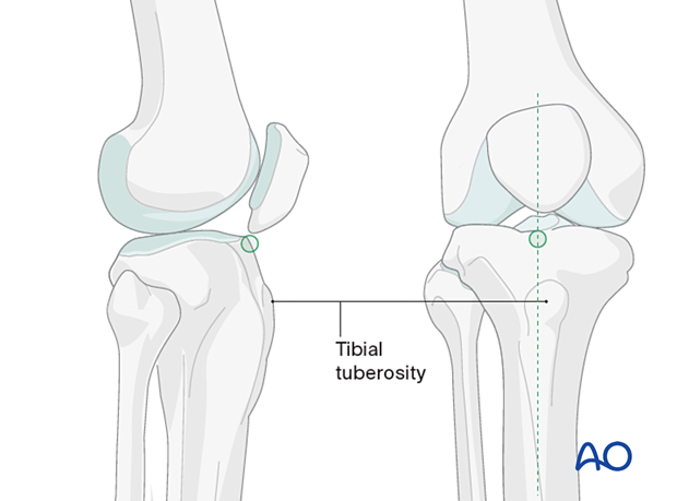 Medial parapatellar approach for intramedullary nailing of the tibial shaft, Determination of the entry point