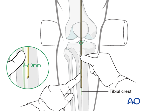 Medial parapatellar approach for intramedullary nailing of the tibial shaft, Determination of the entry point