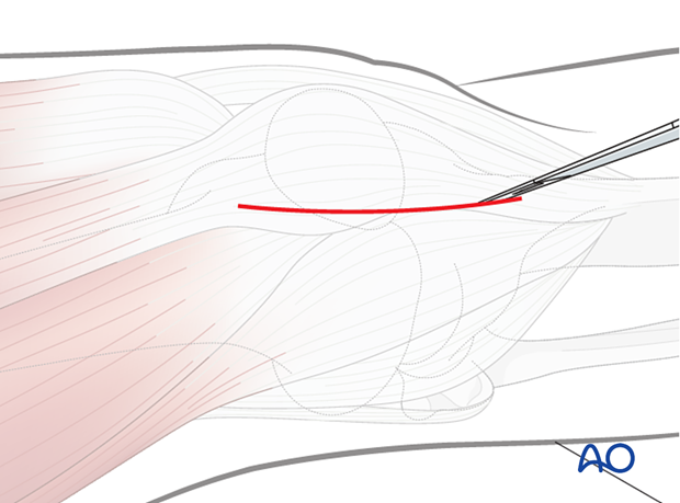 Semi-extended lateral parapatellar approach for intramedullary nailing of the tibial shaft