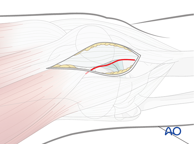 Semi extended lateral parapatellar approach for intramedullary nailing of the tibial shaft, Tendon incision