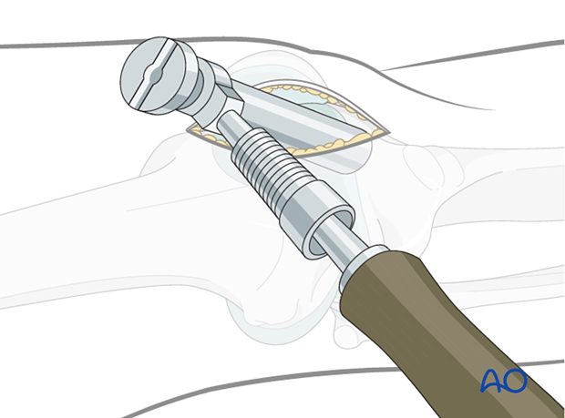 Semi-extended lateral parapatellar approach for intramedullary nailing of the tibial shaft – insertion of the sleeve