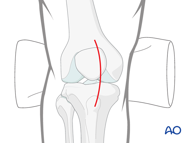 Medial parapatellar approach for intramedullary nailing of the tibial shaft