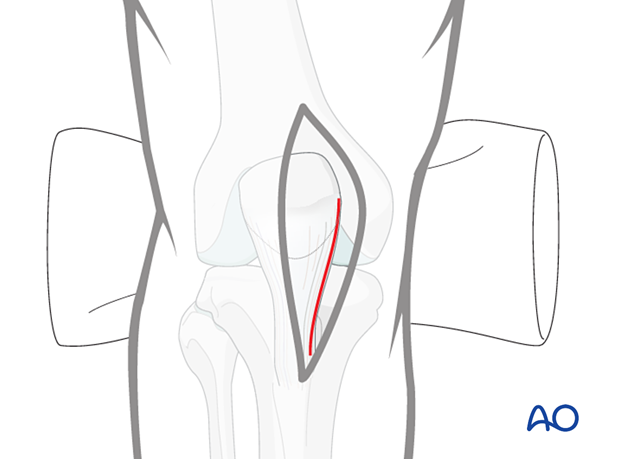 Medial parapatellar approach for intramedullary nailing of the tibial shaft, Tendon incision