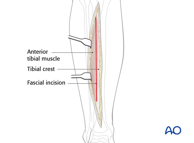 The fascia is incised just lateral to the tibial crest.
