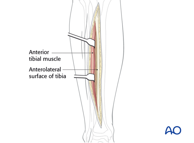 Retraction of the tibialis anterior muscle should be limited
