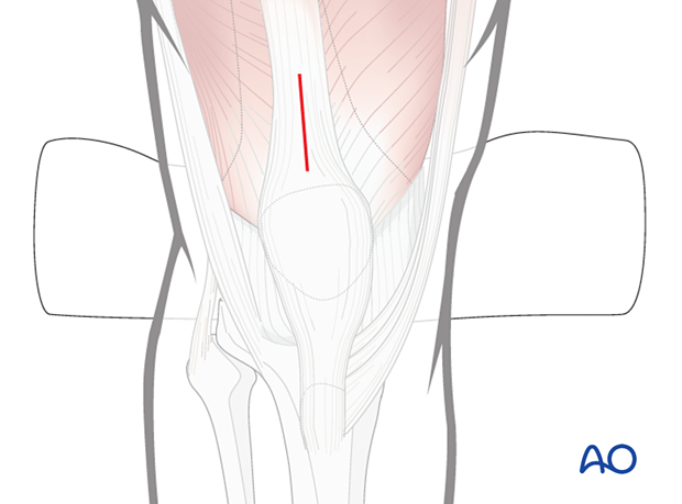Entry point for intramedullary nail in the tibial shaft