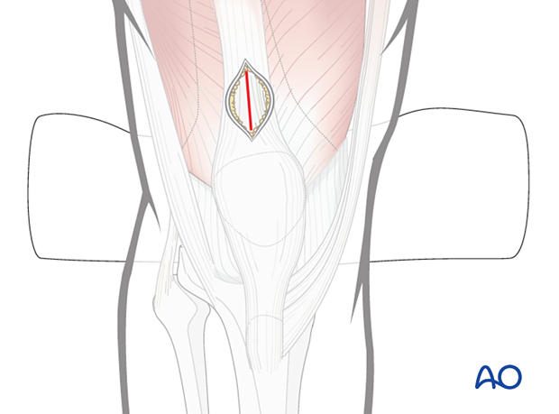 42_A110_i040 Semi-extended suprapatellar approach for intramedullary nailing of the tibial shaft -  quadriceps tendon incision