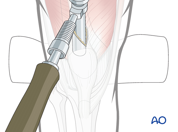 42_A110_i060 Semi-extended suprapatellar approach for intramedullary nailing of the tibial shaft