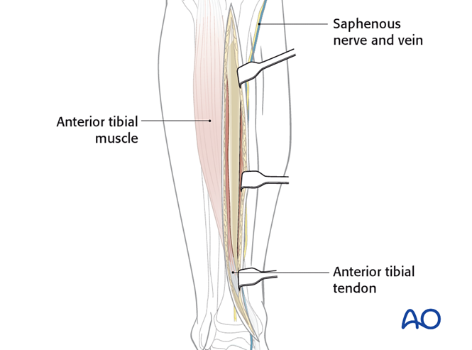 Approach to the anteromedial surface of the tibia