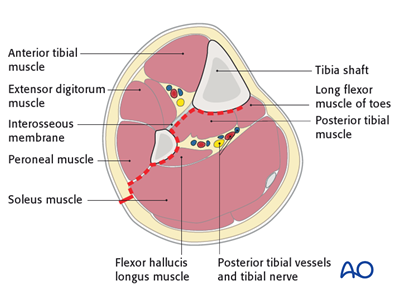 Approach to the posterolateral surface of the tibia