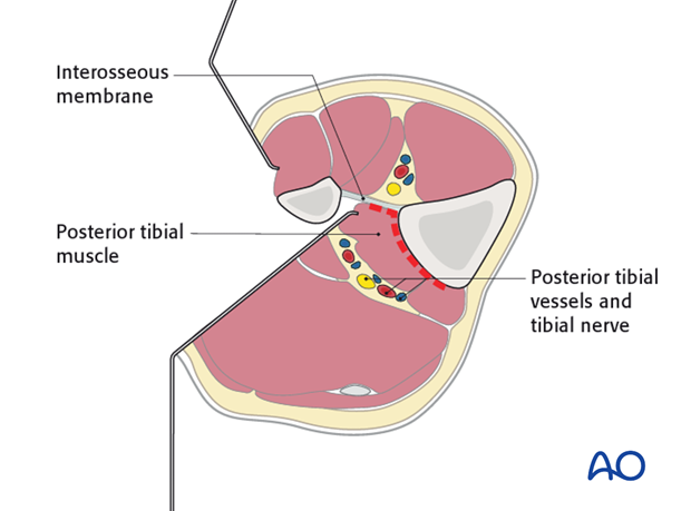 Medial dissection is continued until the interosseus membrane is encountered.