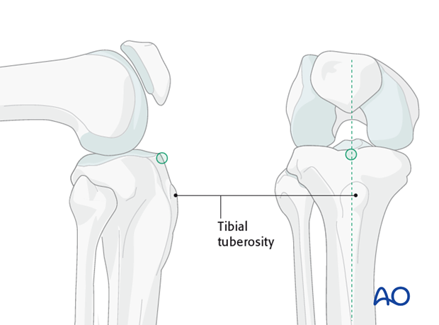 Tibial Pursuit: How to identify and side the tibia