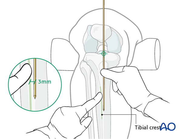 A Review of Proximal Tibia Entry Points for Intramedullary Nailing