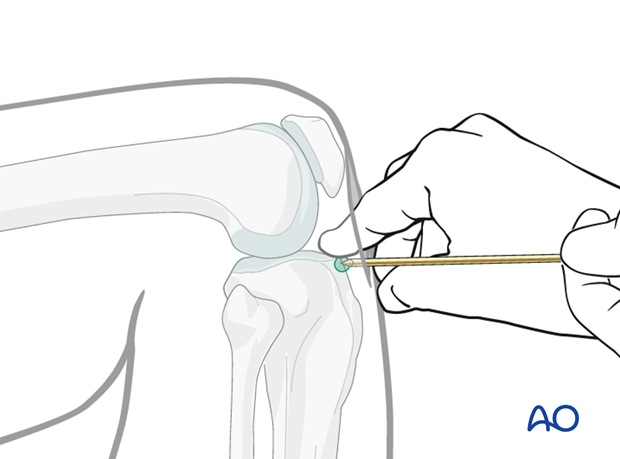 A Review of Proximal Tibia Entry Points for Intramedullary Nailing