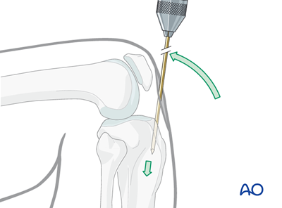 Intramedullary nailing for Simple fracture, oblique