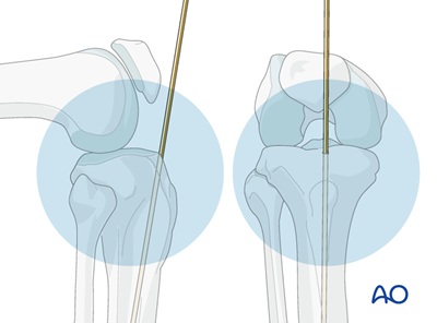 Intramedullary nailing for Simple fracture, oblique