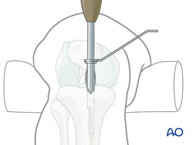 Intramedullary nailing for Simple fracture, oblique