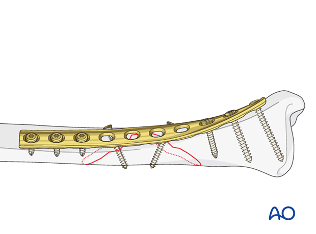 wedge fracture intact wedge