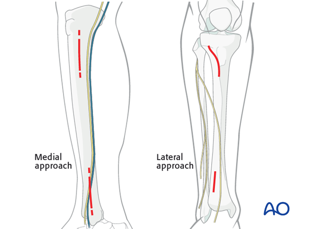 Medial and lateral minimally invasive approaches