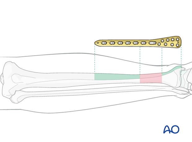 When the fracture zone is very distal or proximal, there may not be room enough for symmetric plate length in the segment...