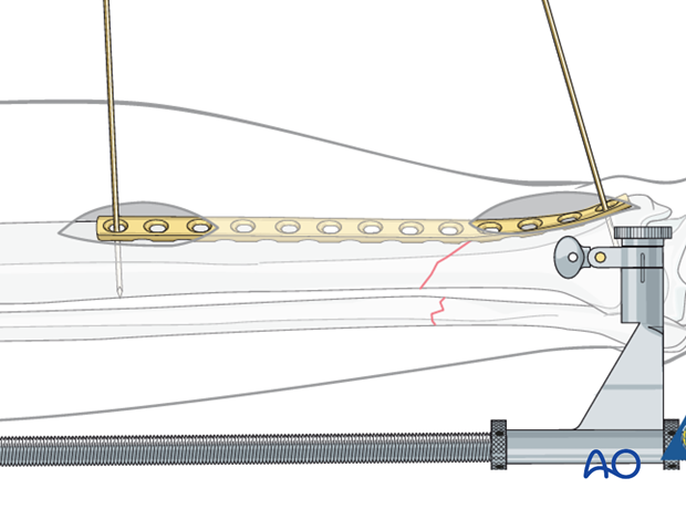 At this point, the plate can be provisionally held with K-wires.