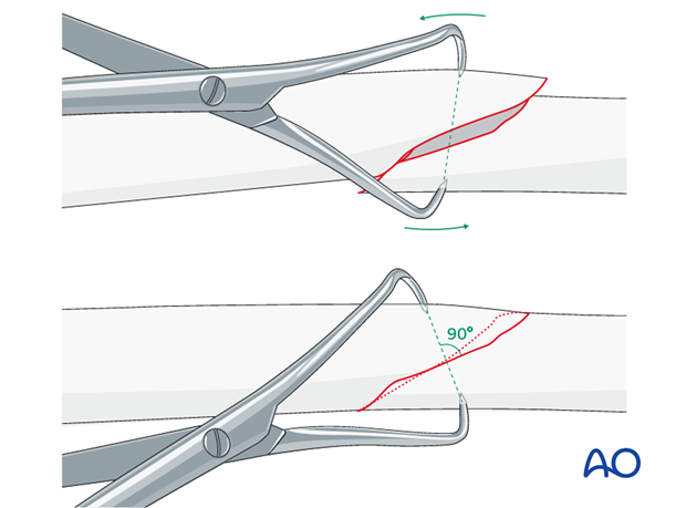 When possible, reduction forceps are a valuable aid.