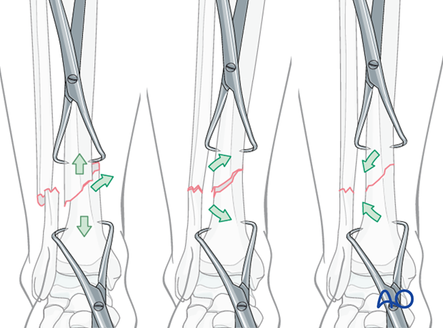 With transverse fractures, the forceps cannot be applied to compress the fracture surfaces...