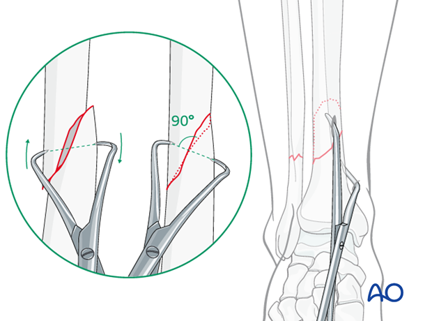 Final reduction of the fracture is done with pointed reduction forceps placed through two stab incisions.