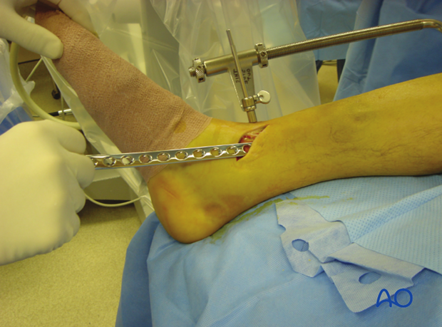 An incision is made over the distal tibia and the plate is slid under the subcutaneous tissues.