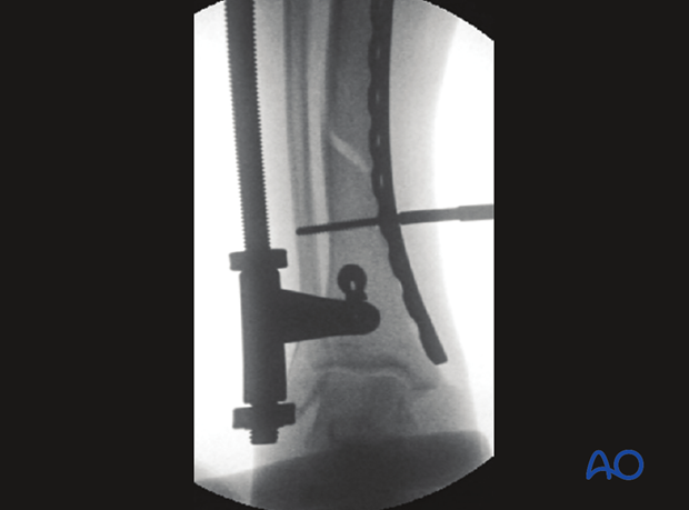 The initial screw must engage both cortices for secure purchase before it is tightened to reduce the fracture.