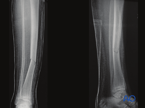 Case example of an A2 tibial shaft fracture 