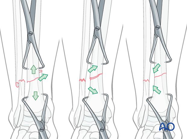 Percutaneous pointed reduction clamps, one in each bone segment, are helpful to adjust the fracture. 