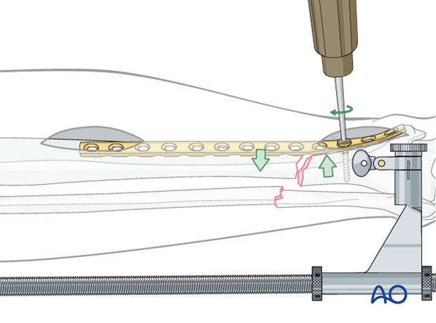 Reduction can also be achieved by reducing the fracture to the plate. 