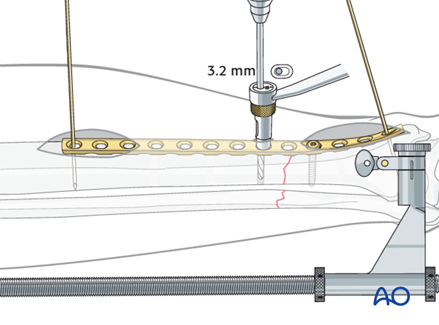 Fracture compression is applied after reduction. 