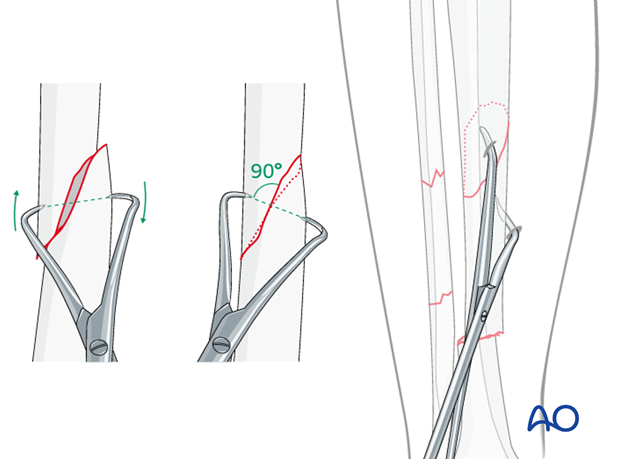 Final reduction may be possible with percutaneously applied pointed reduction forceps.