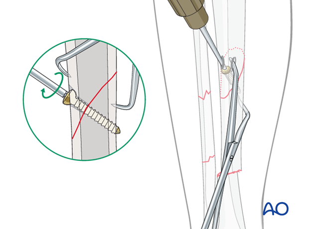 If an oblique fracture is long enough, a percutaneous lag screw can be used to compress the final reduction.