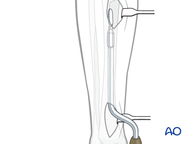 An incision is made over the distal tibia and the plate is slid under the subcutaneous tissues.