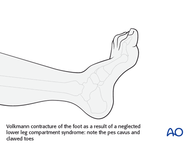 Compartment syndrome