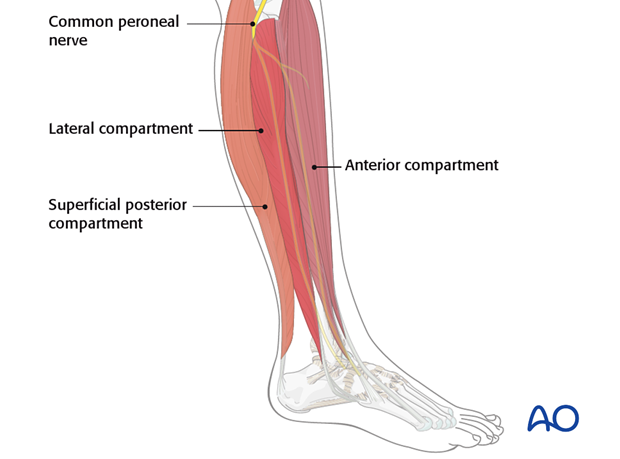 compartment syndrome