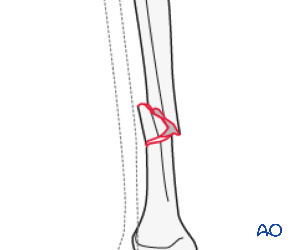 Wedge Fracture, Intact Wedge